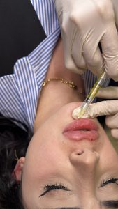 تزریق ژل و فیلر در رشت | حجم‌دهی طبیعی لب و گونه با دکتر روزبه