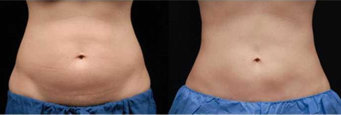 کرایولیپولیز در رشت | روش ایمن و سریع برای لاغری موضعی بدن