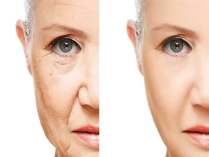 لیزر جوان‌سازی پوست در رشت | درمان لک و چین‌وچروک با تکنولوژی روز