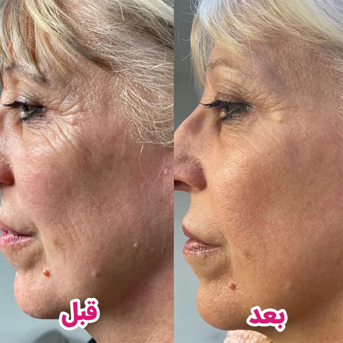 تزریق مزوژل برای جوان‌سازی و رفع چروک؛ راز پوست شفاف و درخشان