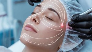 خدمات اندولیفت در رشت | لیفت صورت بدون جراحی و با ماندگاری بالا