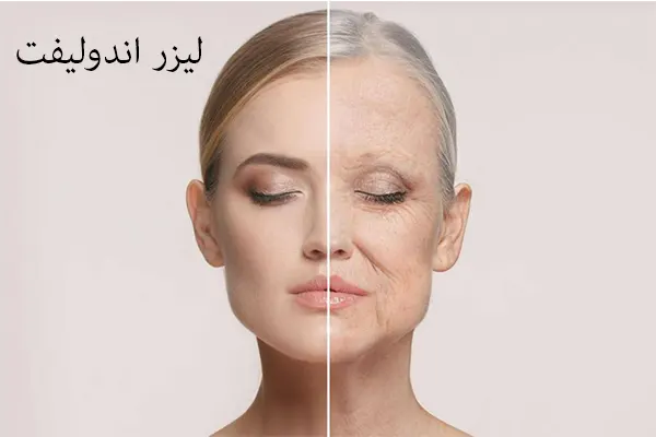 خدمات اندولیفت در رشت | لیفت صورت بدون جراحی و با ماندگاری بالا