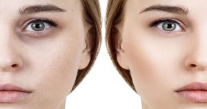 اندولیفت زیرچشم در رشت | رفع گودی و تیرگی بدون جراحی