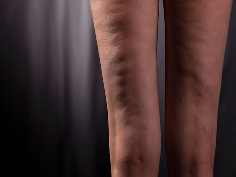 رفع سلولیت در رشت | جدیدترین روش‌های صاف‌کردن پوست بدن