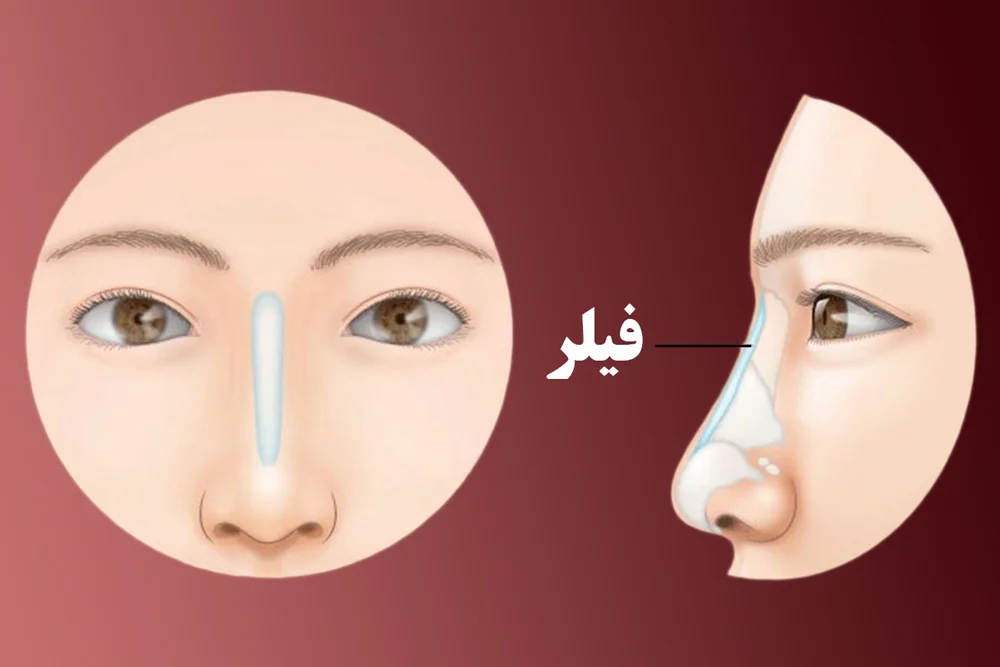 تزریق فیلر بینی در رشت | رفع نواقص بینی بدون جراحی